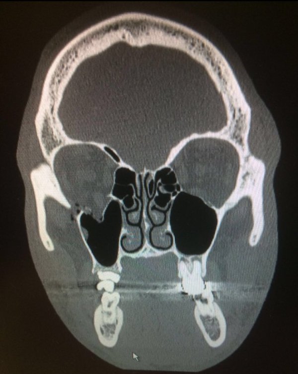 kel-brook-eye-socket